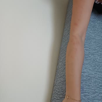 Güzellik Salonu Hizmetinde Randevu Gecikmesi ve Lazer Epilasyon Sonrası Yanık Şikayeti