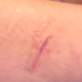 Cerrahi İşlem Yapılmadan Fazla Ücret Alınması Ve Yanlış Faturalandırma