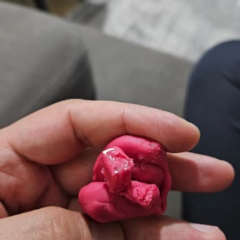 Oyun Hamurunda Cam Ve Yabancı Cisim Şoku