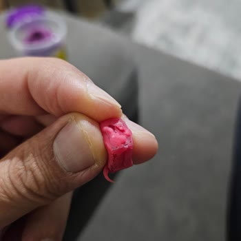 Oyun Hamurunda Cam Ve Yabancı Cisim Şoku