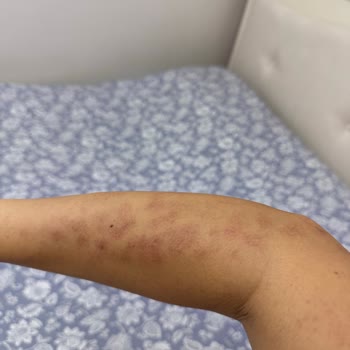 Lazer Epilasyon Sonrası Yanık Ve Yetersiz Klinik Desteği