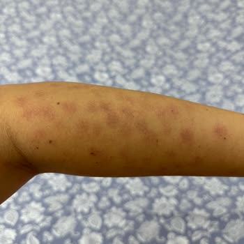 Lazer Epilasyon Sonrası Yanık Ve Yetersiz Klinik Desteği