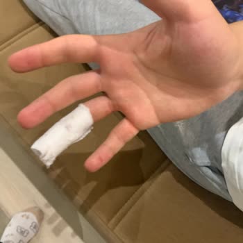 Konserve Kapağı Tehlikeli Açılırken Çocuğumun Parmağı Derin Kesildi