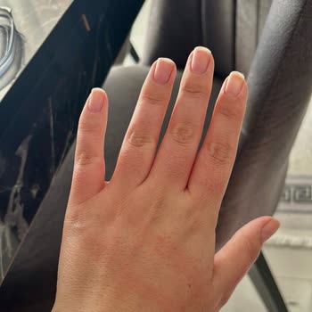 Baby Me Leke Çıkarıcı Kullanımı Sonrası Elde Ve Bebekte Yanık Ve Tahriş Oluştu