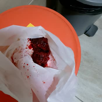 Doğum Sonrası Yanlış Ve Acımasız Müdahale Nedeniyle Yaşadığım Sağlık Sorunları