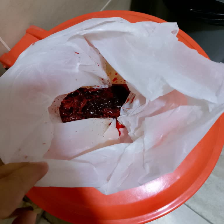 Doğum Sonrası Yanlış Ve Acımasız Müdahale Nedeniyle Yaşadığım Sağlık Sorunları