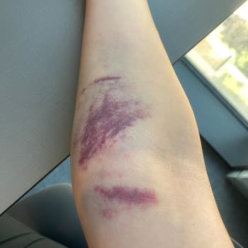 Acil Serviste Yanlış Kan Alımı Sonucu Kolumda Şişlik Ve Morarma Oluştu