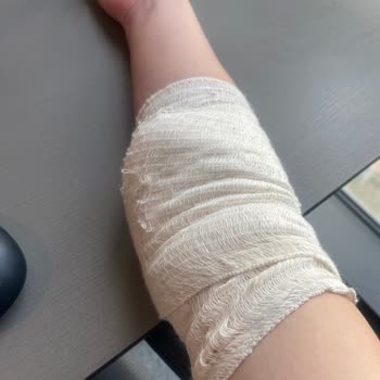 Acil Serviste Yanlış Kan Alımı Sonucu Kolumda Şişlik Ve Morarma Oluştu