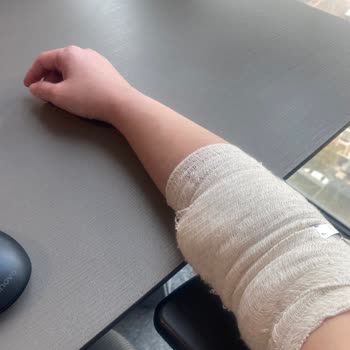 Acil Serviste Yanlış Kan Alımı Sonucu Kolumda Şişlik Ve Morarma Oluştu