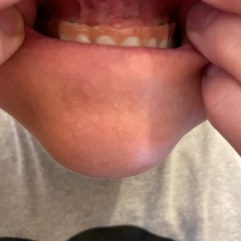 İmplant Sonrası Protezde Renk Ve Rahatsızlık Sorunu, Garanti Kapsamında Çözüm Talebi