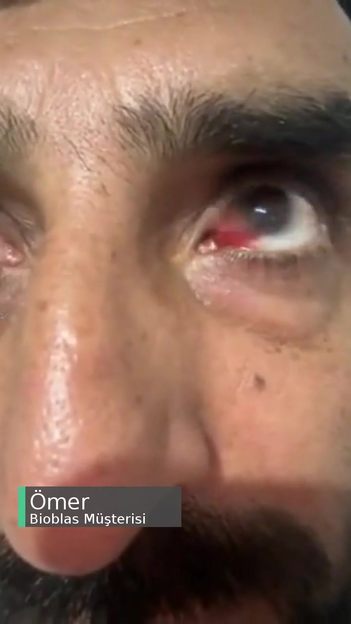 Kimyasal Şampuan Bioblas Göz Hasarına Sebep Oldu! videonun kapak resmi