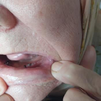 Yanlış Takılan İmplant Ve İlgisiz Doktor Yaşlı Annemi Mağdur Etti