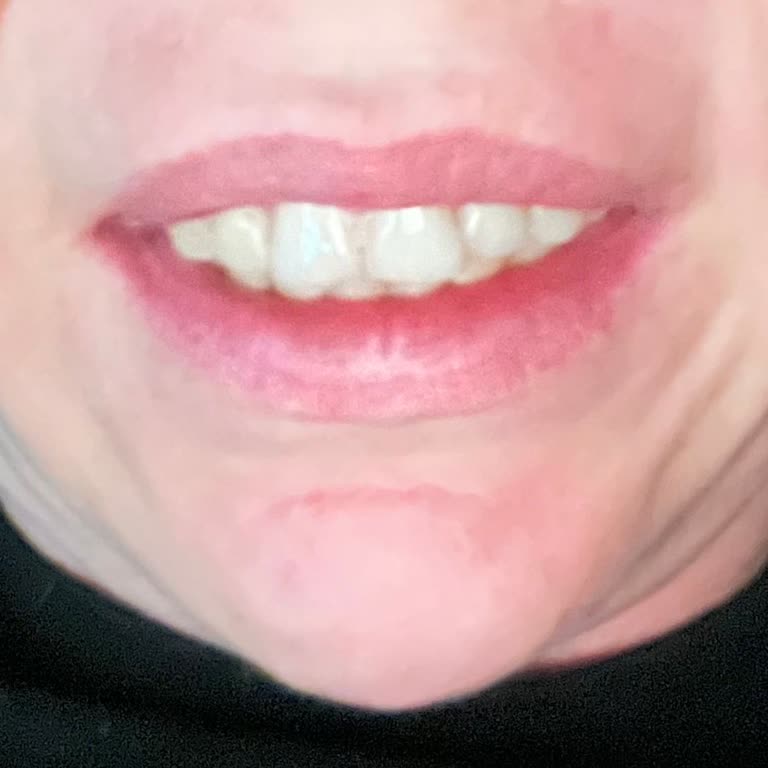 Botoks Sonrası Yüzümde Donukluk Ve Asimetri Oluştu, Sosyal Hayatım Etkilendi