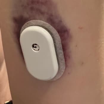 Sibionics Türkiye Cgm Cihazlarında Yaşanan Ciddi Sorunlar Ve Müşteri Hizmetleri Mağduriyeti