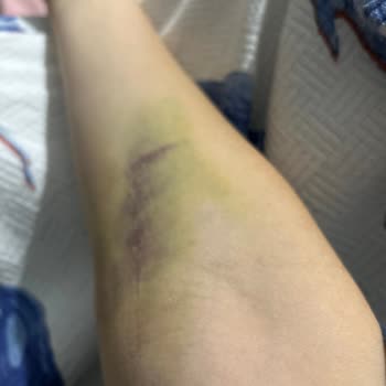 Serum Uygulaması Sonrası Morarma Ve Yetersiz Bilgilendirme