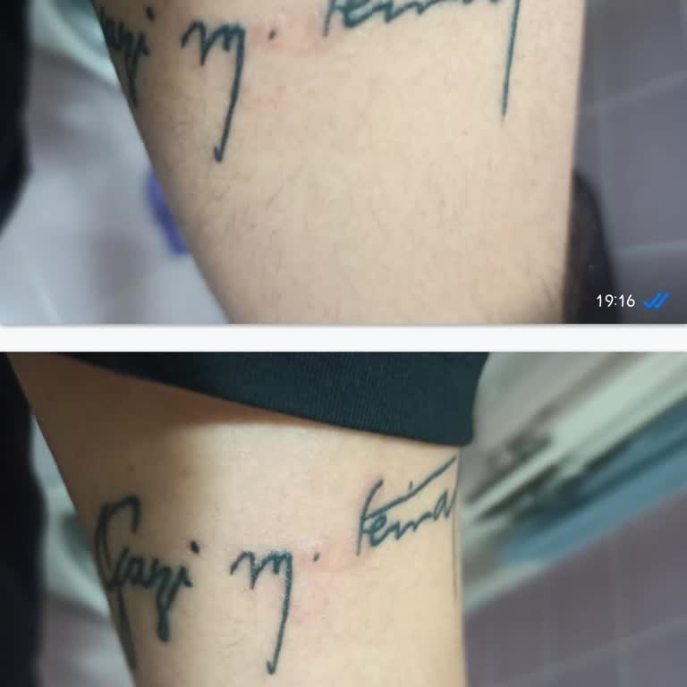 Enza Güzellik Merkezi'nde Başarısız Epilasyon Ve Dövmeye Zarar Veren Uygulama Mağduriyeti