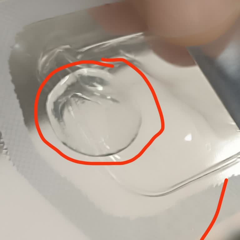 Bezmiâlem Hastanesi Ameliyat Sonrası Gözde Unutulan Lens Nedeniyle Mağduriyet