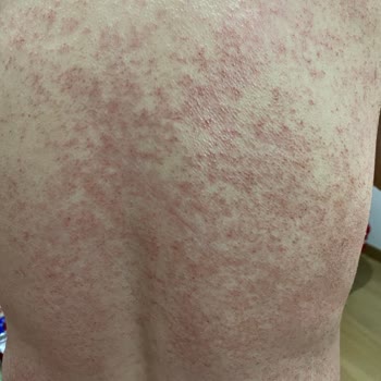 Epify Tüy Dökücü Cildimde Ciddi Kızarıklık Ve Yanma Yaptı