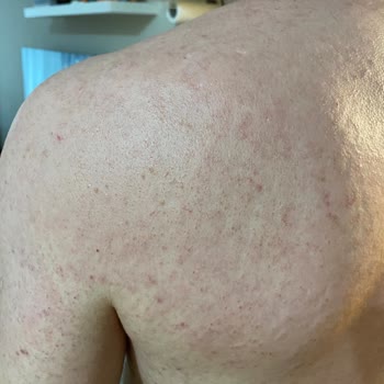 Epify Tüy Dökücü Cildimde Ciddi Kızarıklık Ve Yanma Yaptı