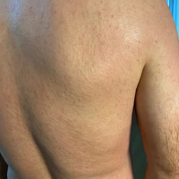 Epify Tüy Dökücü Cildimde Ciddi Kızarıklık Ve Yanma Yaptı