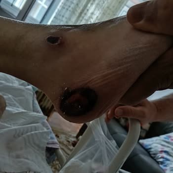 Yoğun Bakımda Annemin Bakım İhmali Nedeniyle Yaşadığı Mağduriyet