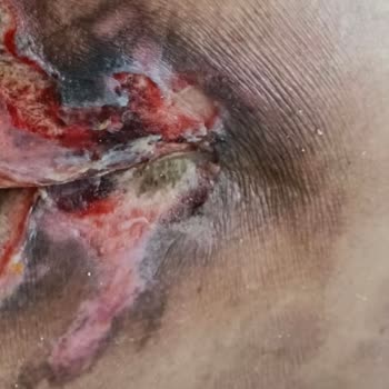 Yoğun Bakımda Annemin Bakım İhmali Nedeniyle Yaşadığı Mağduriyet