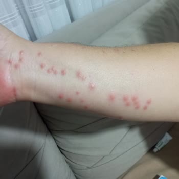 Kıbrıs Mersin Seferinde Tahtakurusu Nedeniyle Ciddi Sağlık Sorunları Yaşadık