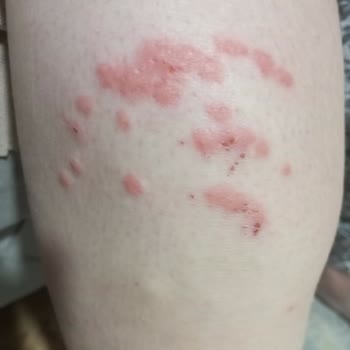 Kıbrıs Mersin Seferinde Tahtakurusu Nedeniyle Ciddi Sağlık Sorunları Yaşadık