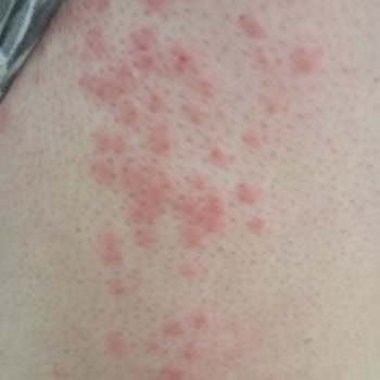 Kıbrıs Mersin Seferinde Tahtakurusu Nedeniyle Ciddi Sağlık Sorunları Yaşadık