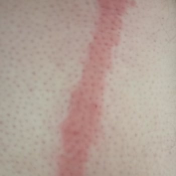 Kıbrıs Mersin Seferinde Tahtakurusu Nedeniyle Ciddi Sağlık Sorunları Yaşadık