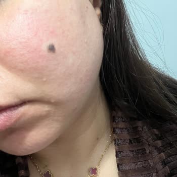 Yves Rocher Sebo Active Clear Tonik Ve Serumda Ciddi Cilt Reaksiyonu Ve Mağduriyet!