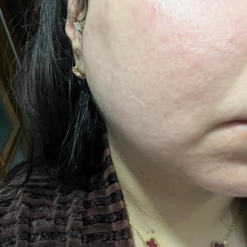 Yves Rocher Sebo Active Clear Tonik Ve Serumda Ciddi Cilt Reaksiyonu Ve Mağduriyet!