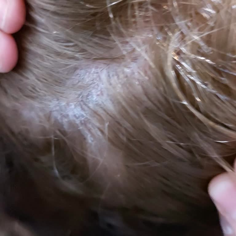 Saç Boyası Kullanımı Sonrası Kepeklenme Ve Yaralar Nedeniyle Mağduriyet