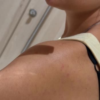 Lazer Epilasyon Sonrası Artan Tüyler Ve Yetersiz Müşteri Hizmeti