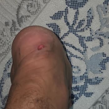 Aldığım Ayakkabı Ciddi Şekilde Ayağımı Yaraladı, Mağaza Çözüm Sunmadı