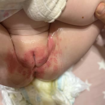 Molfix Bez Ciddi Pişiğe Ve Mantara Yol Açtı, Çözüm Bekliyorum