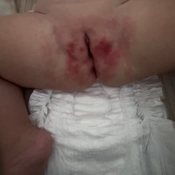 Molfix Bez Ciddi Pişiğe Ve Mantara Yol Açtı, Çözüm Bekliyorum