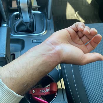 Stanley Termosun Kapağı Güvenlik Riski Oluşturdu, Yanık Ve Mağduriyet Yaşadım