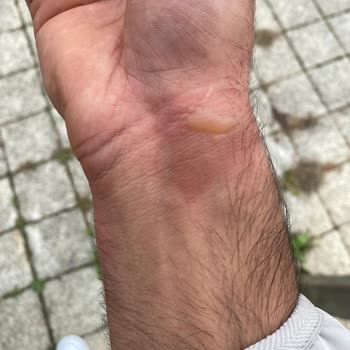 Stanley Termosun Kapağı Güvenlik Riski Oluşturdu, Yanık Ve Mağduriyet Yaşadım