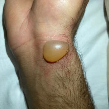 Stanley Termosun Kapağı Güvenlik Riski Oluşturdu, Yanık Ve Mağduriyet Yaşadım