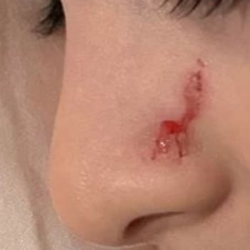 Çocuğumun Anaokulunda Darp Edilmesi Ve Yönetimin İlgisizliği Sonucu Mağduriyet