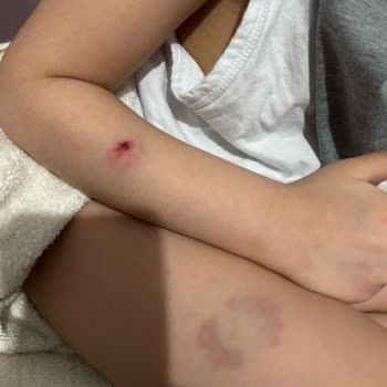 Çocuğumun Anaokulunda Darp Edilmesi Ve Yönetimin İlgisizliği Sonucu Mağduriyet