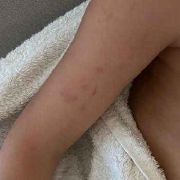 Çocuğumun Anaokulunda Darp Edilmesi Ve Yönetimin İlgisizliği Sonucu Mağduriyet