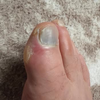 Aldığım Ayakkabı Ayağımı Morarttı, Adidas'tan Dönüş Alamıyorum