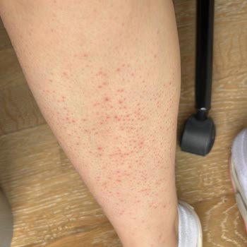 Lazer Epilasyon Sonrası Yanık Ve Mağduriyet: Ücret İadesi Ve Tedavi Masrafları Talebim