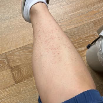 Lazer Epilasyon Sonrası Yanık Ve Mağduriyet: Ücret İadesi Ve Tedavi Masrafları Talebim