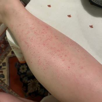 Lazer Epilasyon Sonrası Yanık Ve Mağduriyet: Ücret İadesi Ve Tedavi Masrafları Talebim