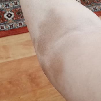 Hamilelikte Yapılan Yanlış Serum Uygulaması Sonucu Kolumda Kalıcı İz Oluştu