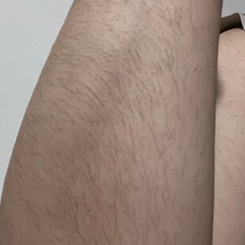 Lazer Epilasyon Sonrası Hiçbir Fayda Görmedim, Klinik Sorumluluk Almadı