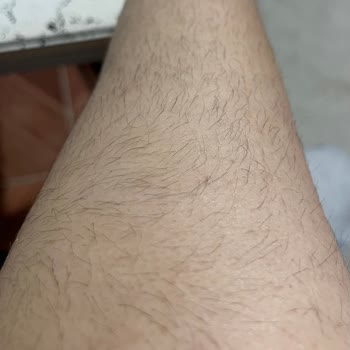 Lazer Epilasyon Sonrası Hiçbir Fayda Görmedim, Klinik Sorumluluk Almadı